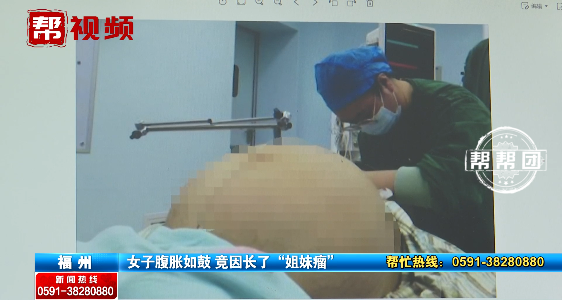 一位23岁的女性，腹部胀满，取出一个42公斤的肿瘤:肿瘤介于良性和恶性之间。